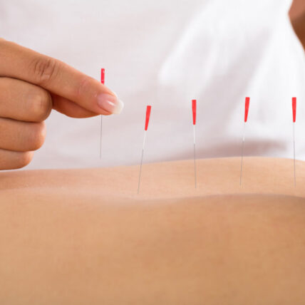 Person Receiving Acupuncture Treatment