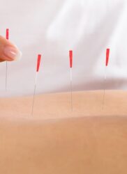 DRY NEEDLING