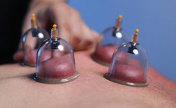 cupping therapy