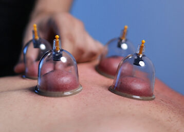 cupping therapy