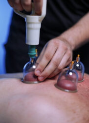 CUPPING Therapy