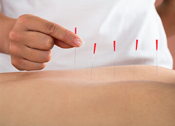 needling therapy